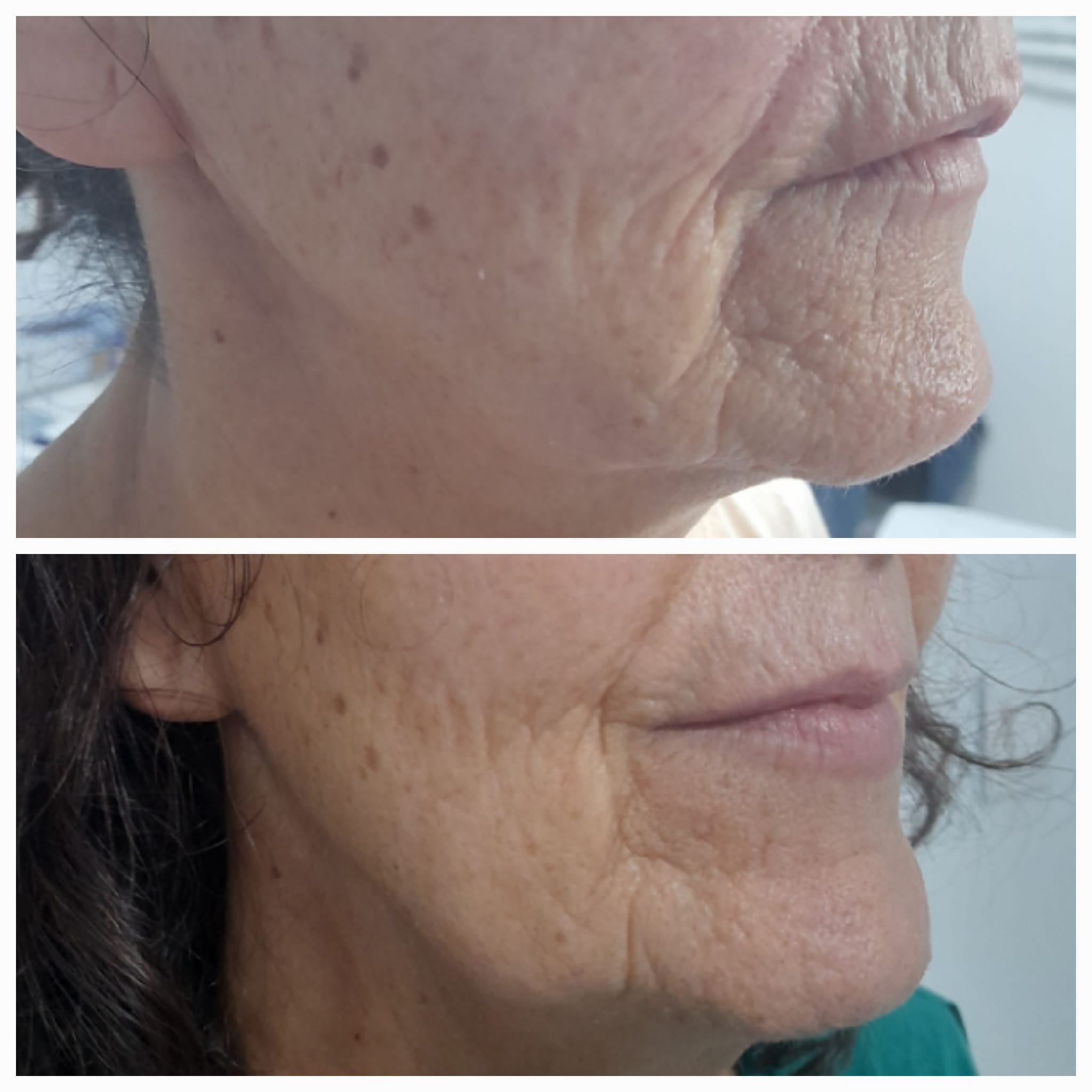 Firmeza Facial