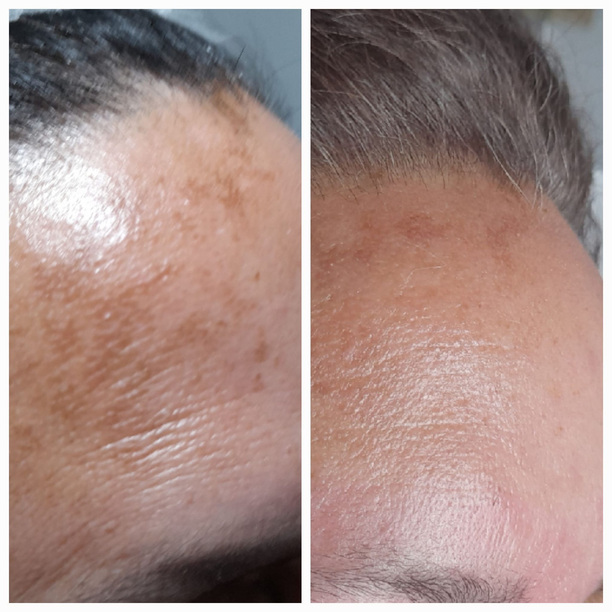 Despigmentación Facial