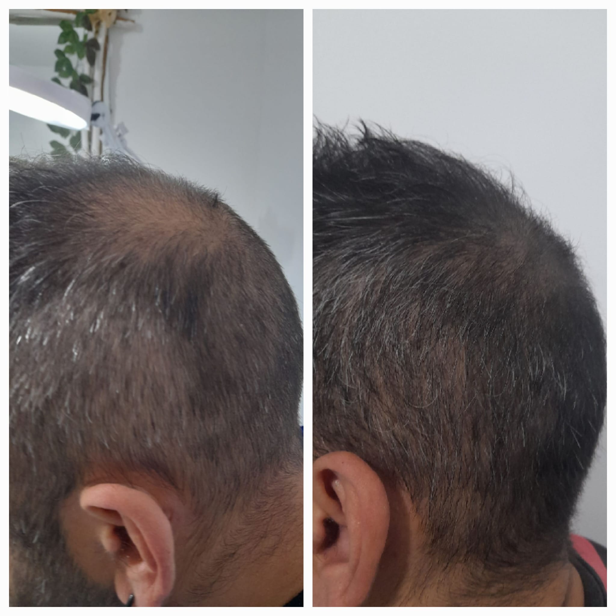 Proceso de Tricopigmentación