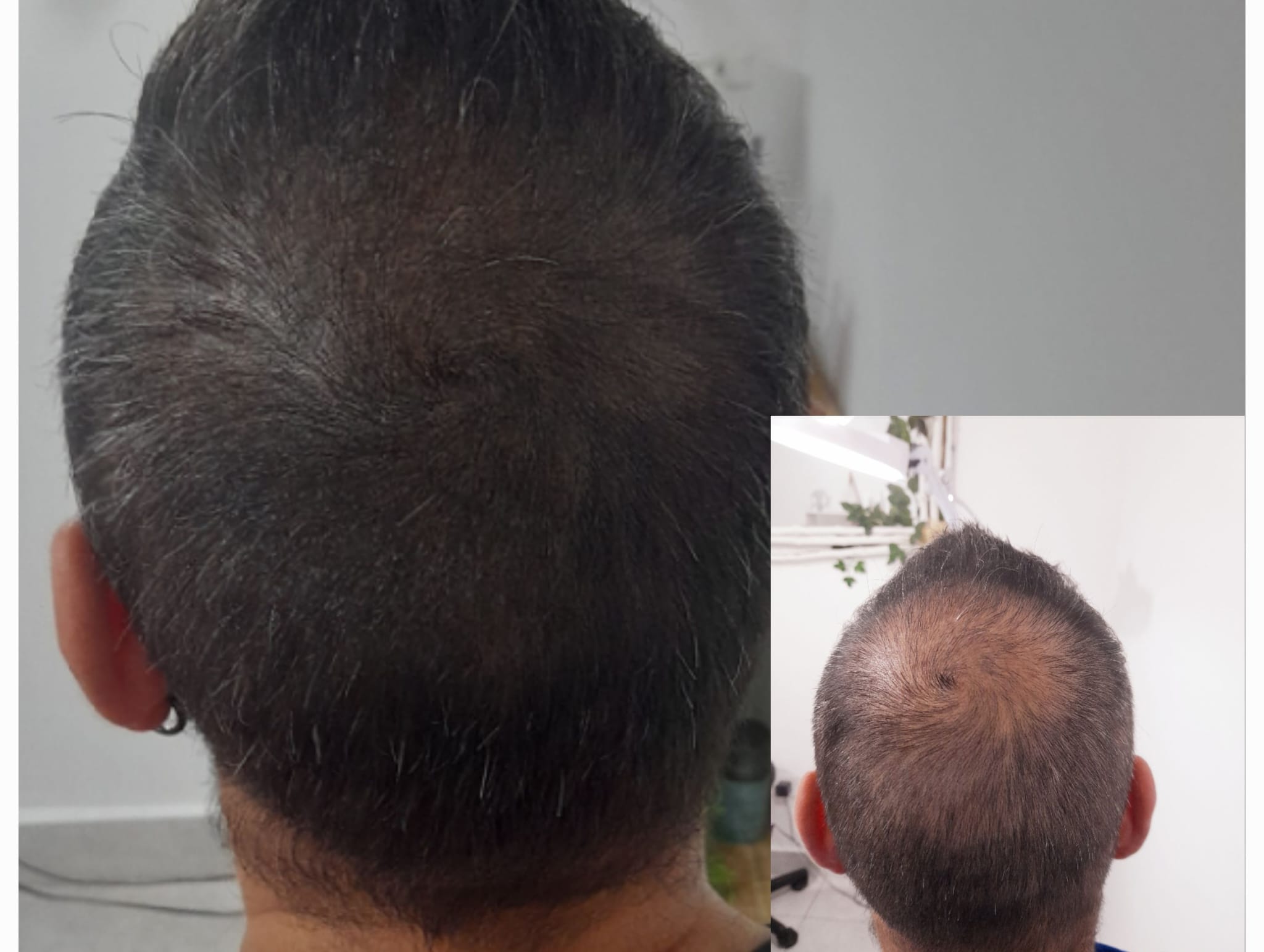 Tricopigmentación Evolución