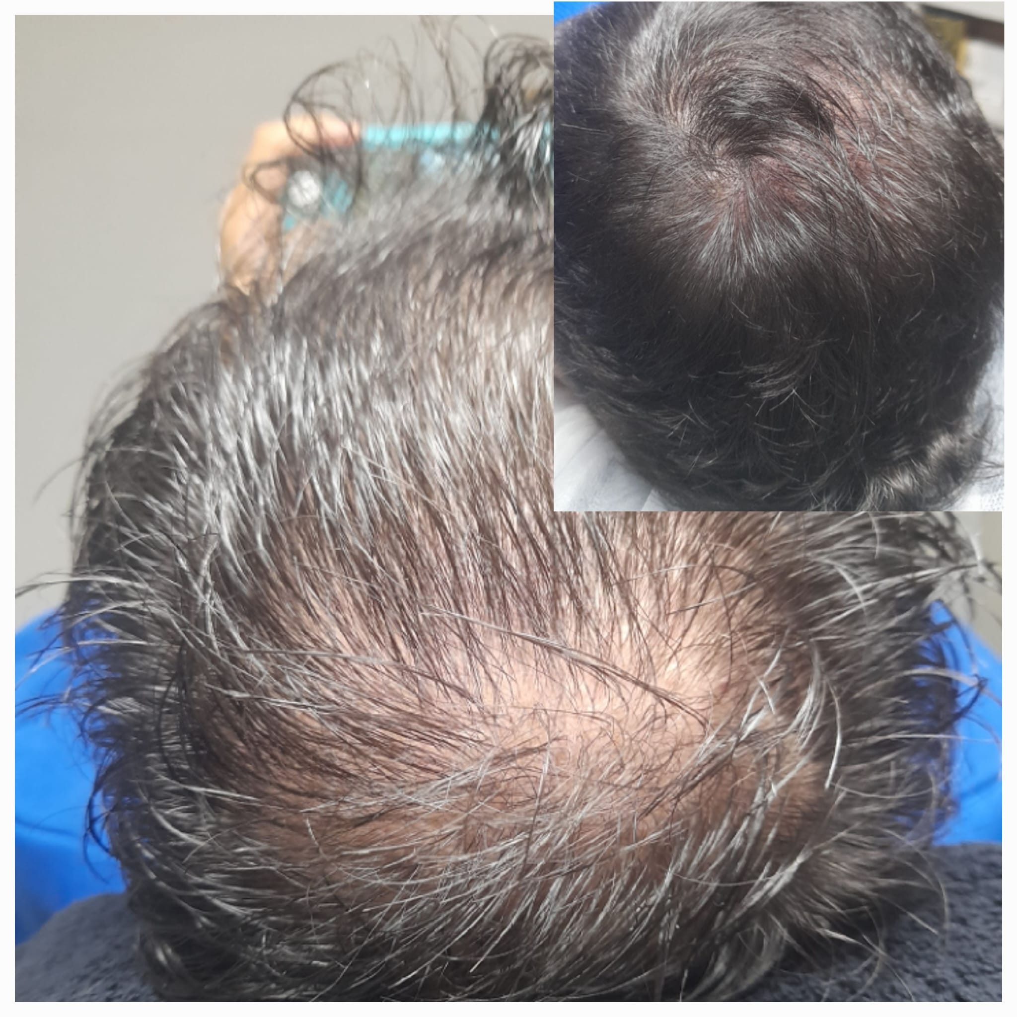 Tricopigmentación