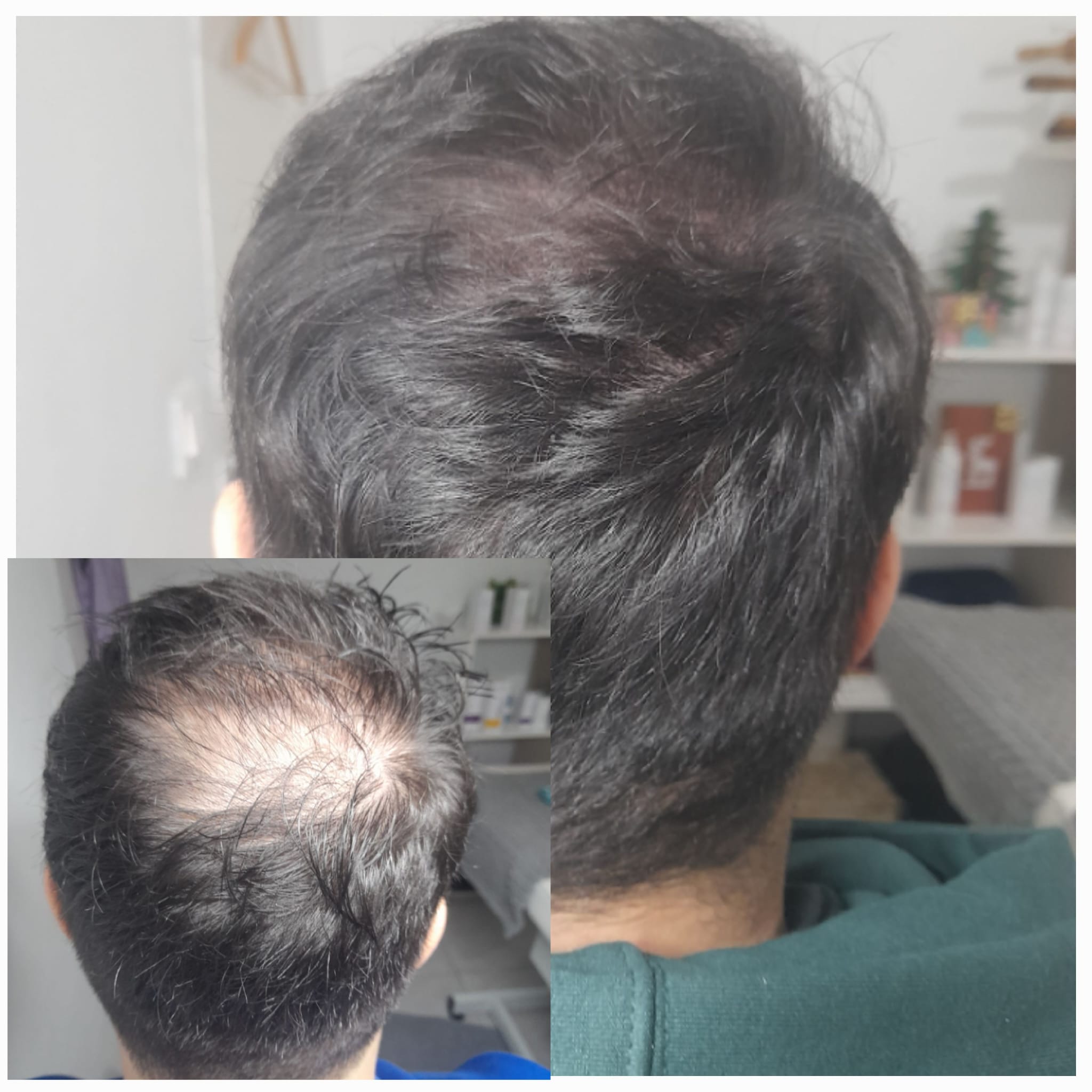 Tricopigmentación resultado 4
