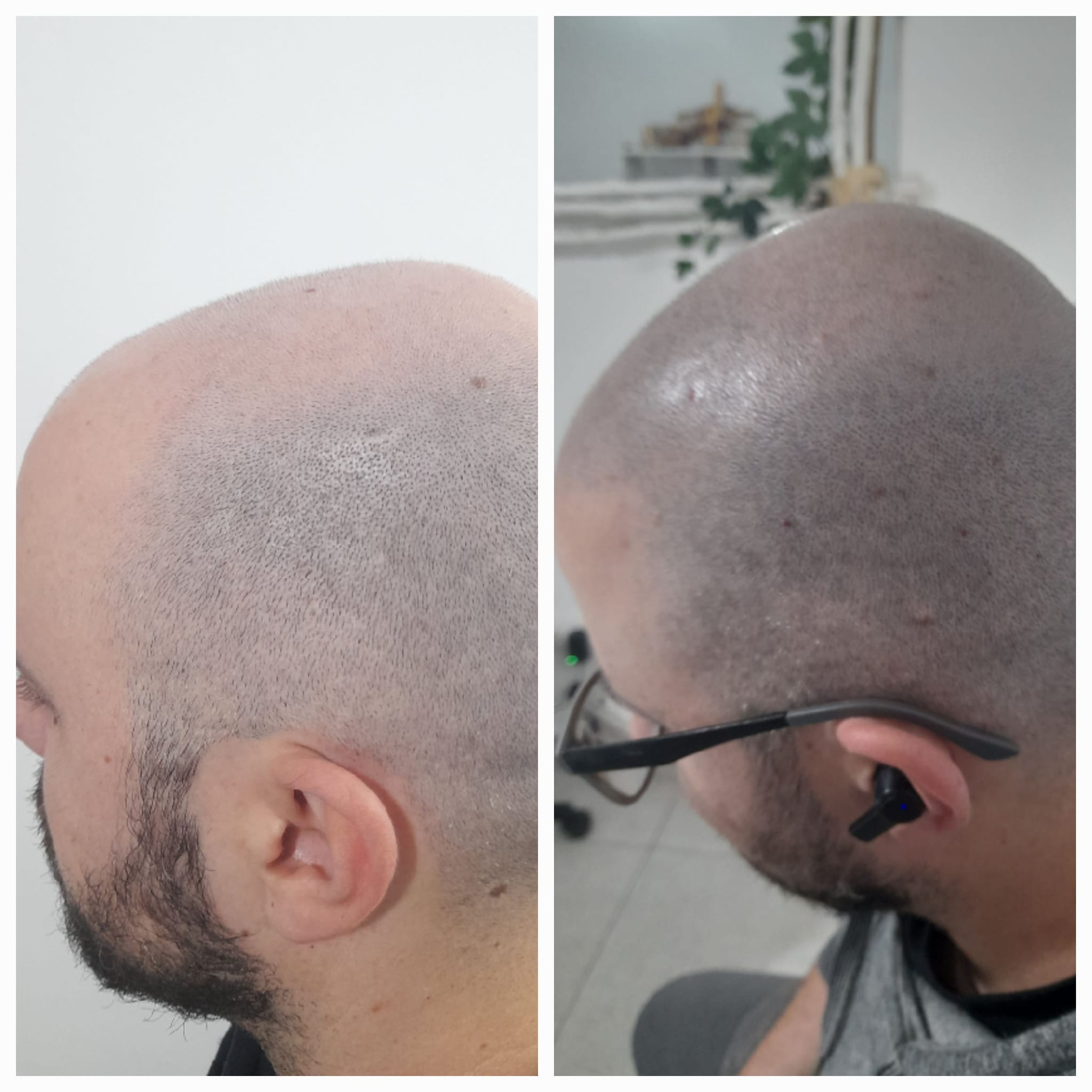 Tricopigmentación Efecto Rapado