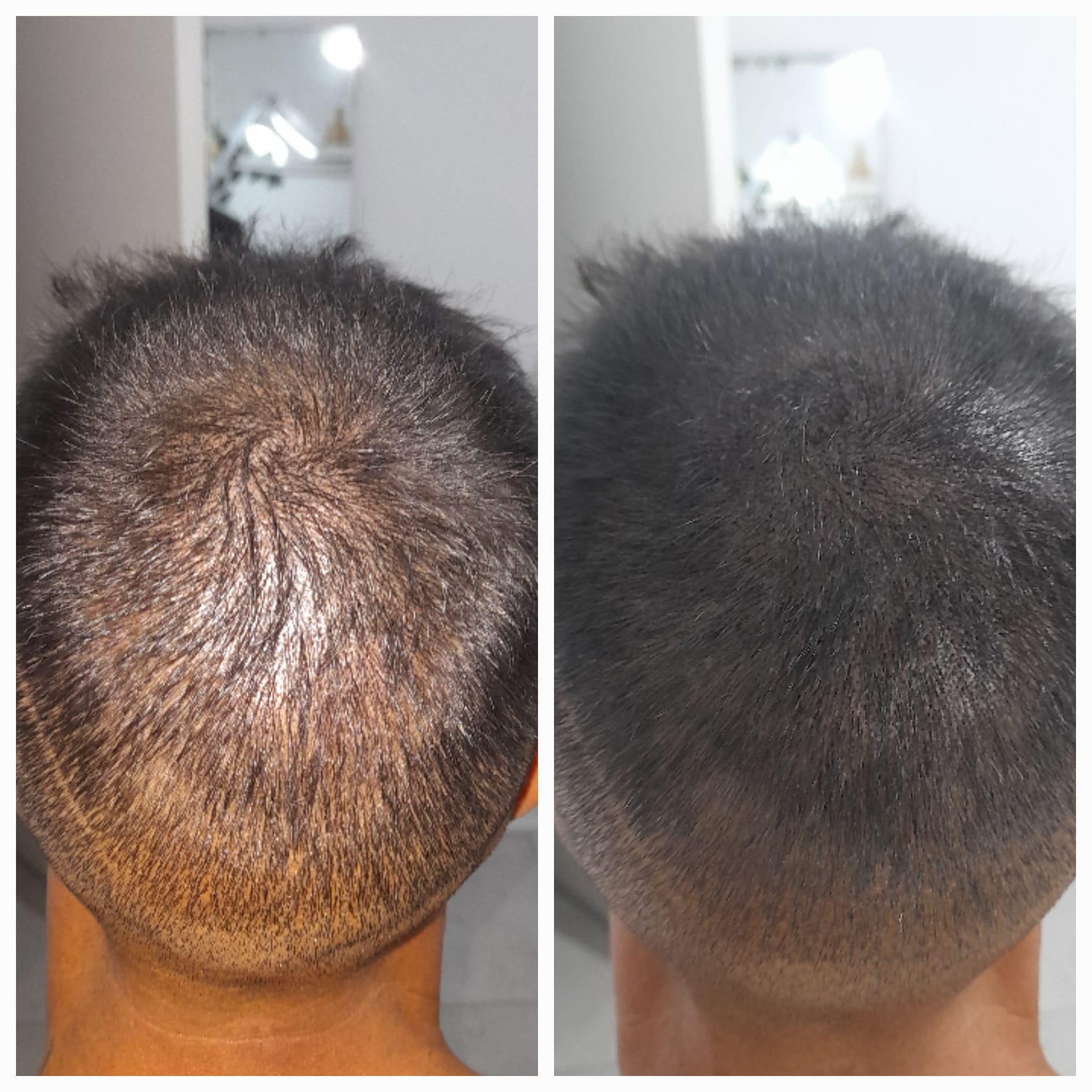 Tricopigmentación Densidad